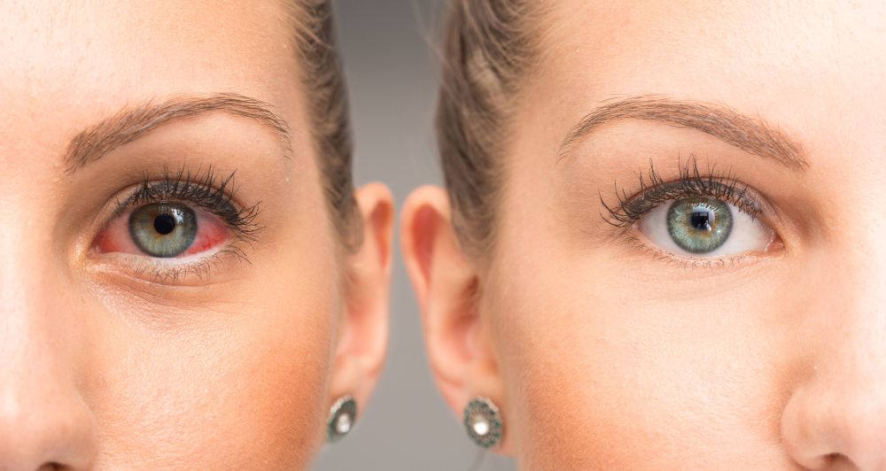 Nużeniec – przyczyna dokuczliwej choroby oczu i skóry
