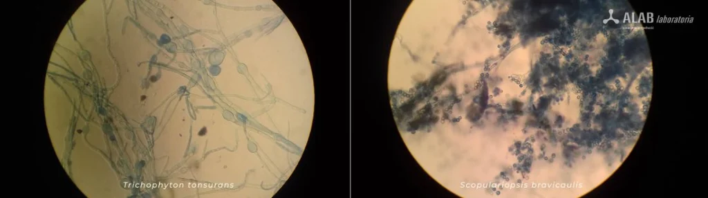 dermatofity widoczne pod mikroskopem