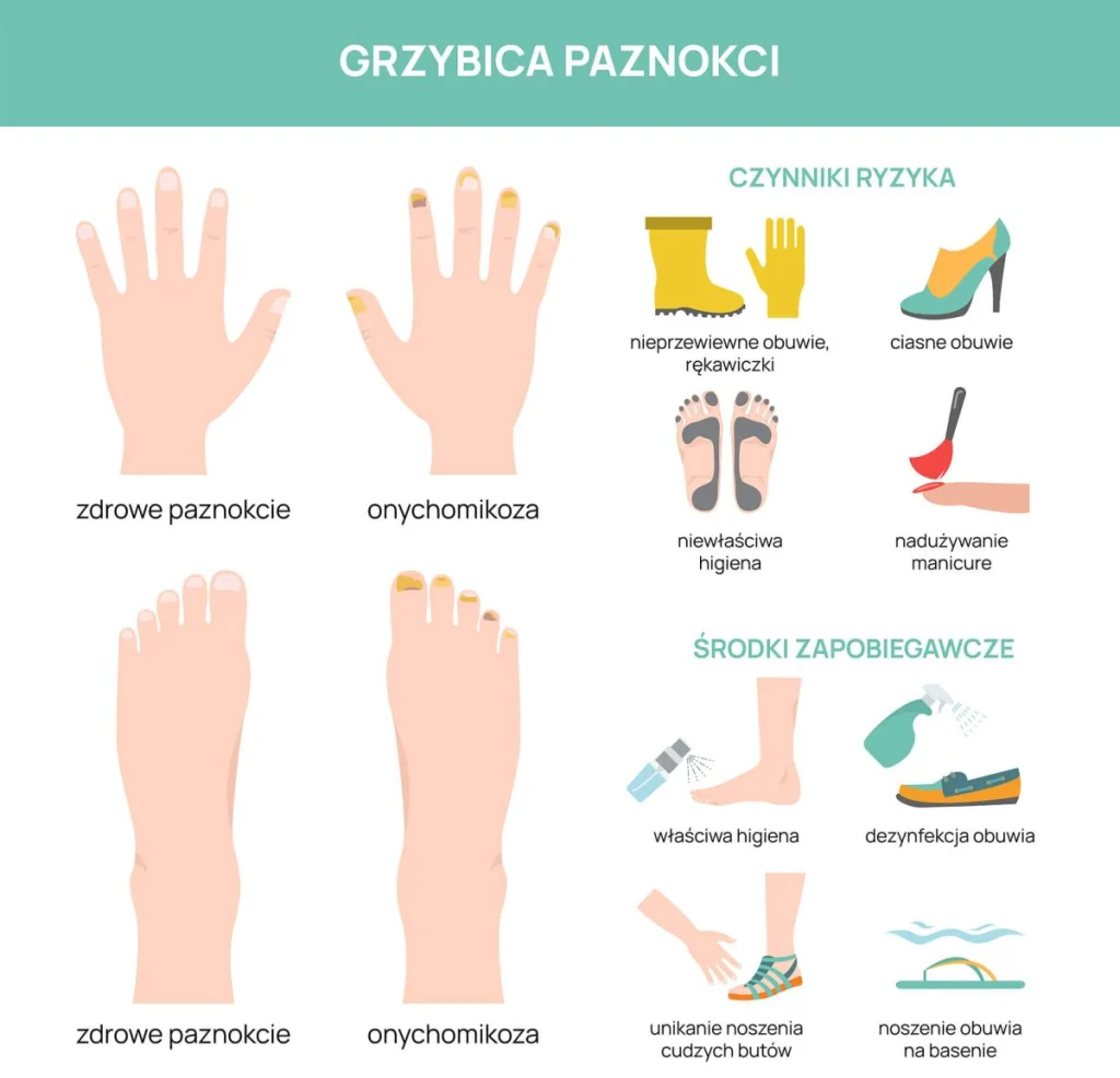 grzybica paznokci - czynniki ryzyka i środki zapobiegawcze