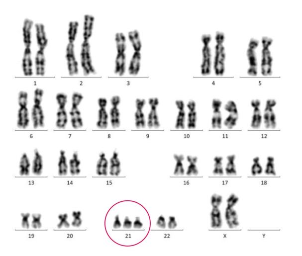 nieprawidłowy kariotyp z trisomią chromosomu 21 (zespół Downa)