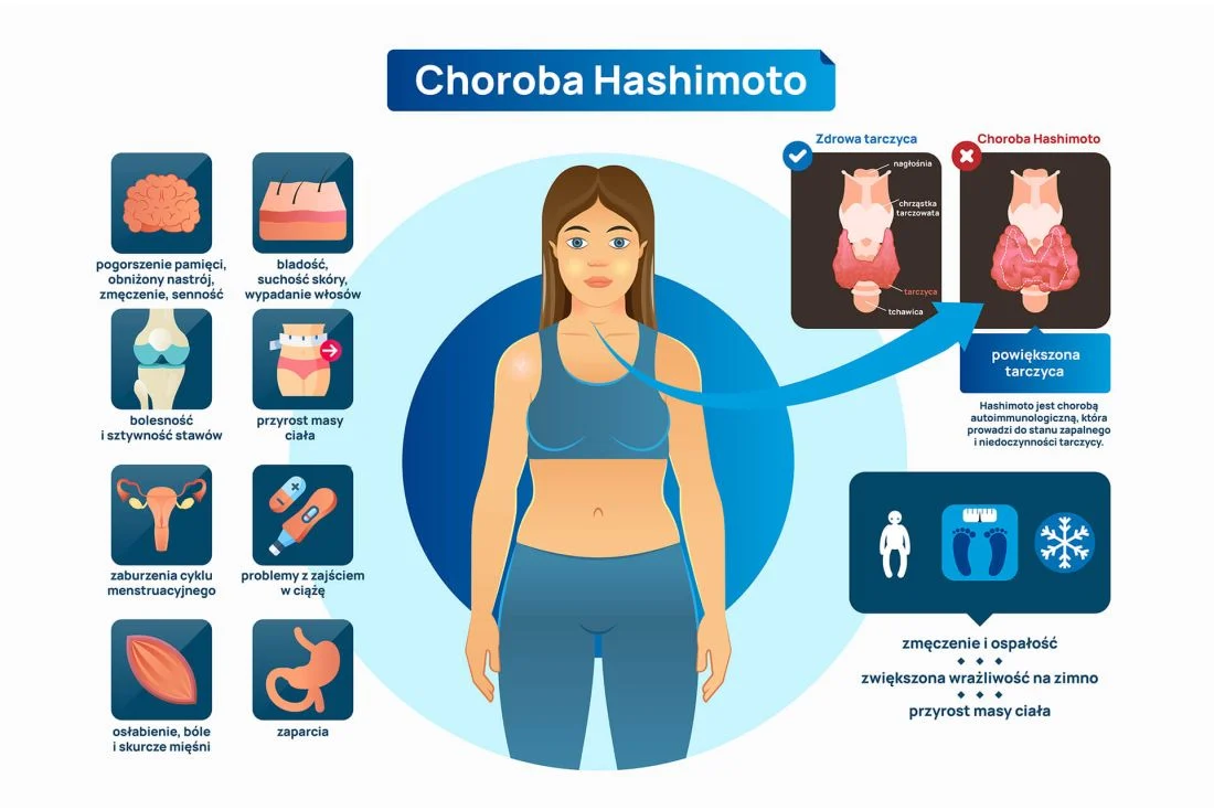 objawy choroby Hashimoto infografika