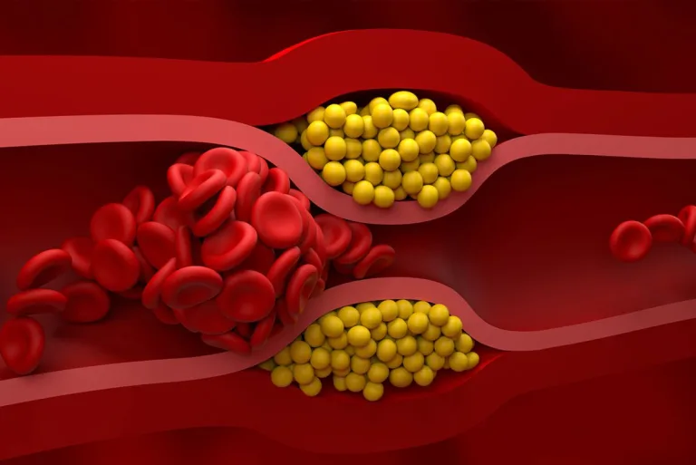 Cholesterol nie-HDL – holistyczne podejście do monitorowania zaburzeń metabolicznych