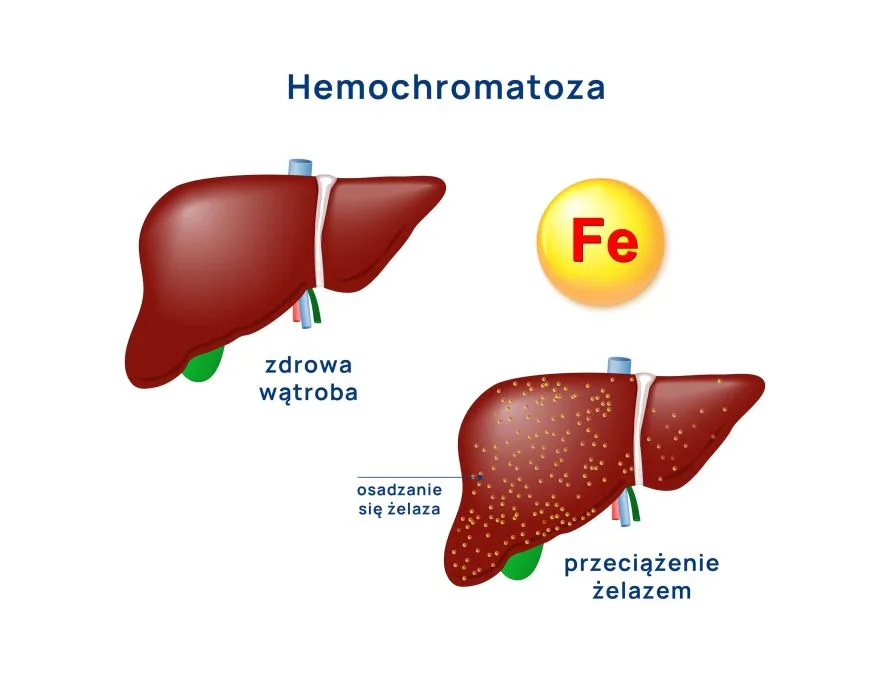 hemochromatoza wpływ na wątrobę infografika