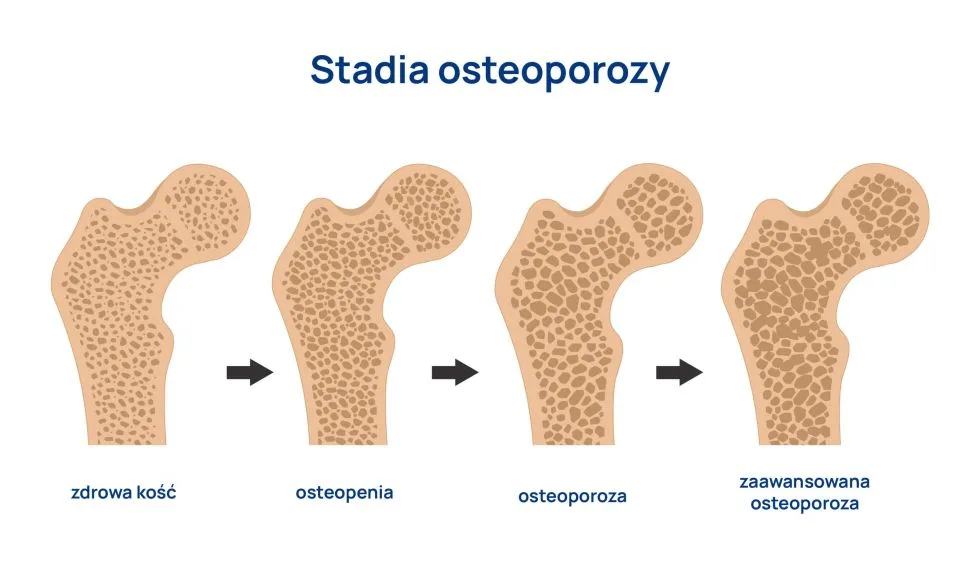 stadia osteoporozy