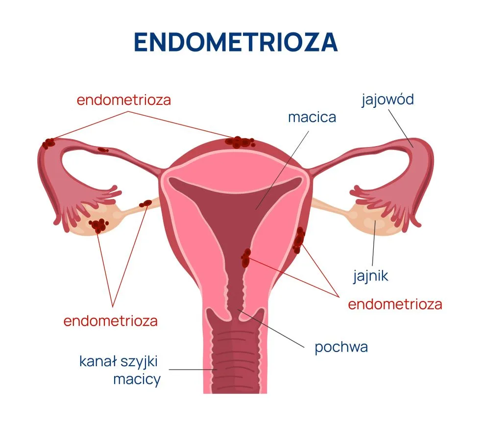 lokalizacje endometriozy infografika