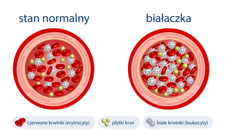 białaczka obraz krwinek i płytek krwi infografika