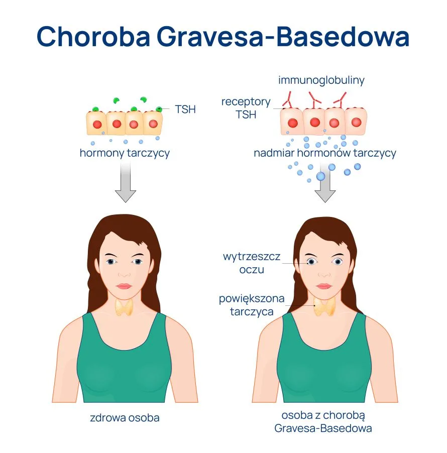 choroba Gravesa-Basedowa infografika