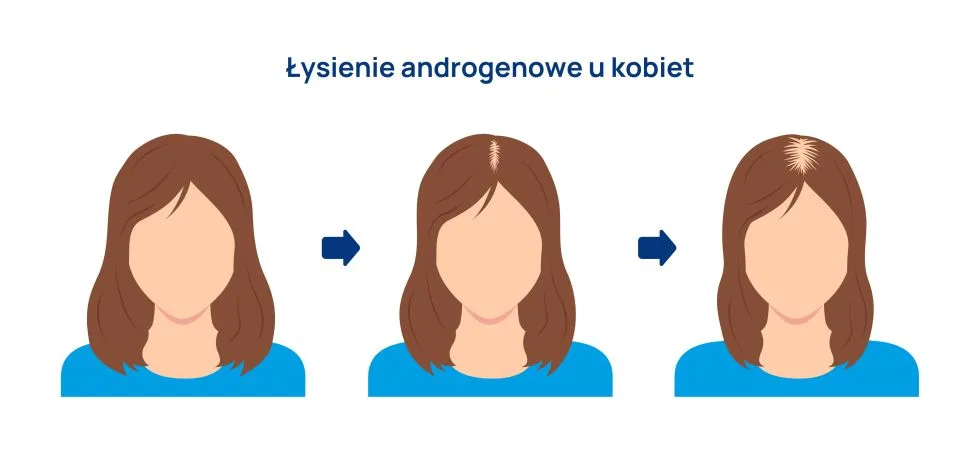 łysienie androgenowe u kobiet infografika