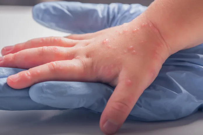 Pokrzywka na dłoni u dziecka. Bąble i obrzęk na skórze w wyniku pokrzywki alergicznej u dzieci.
