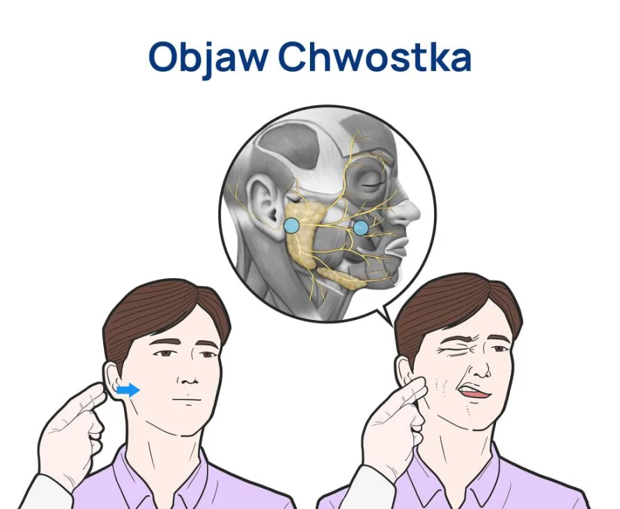 objaw Chwostka