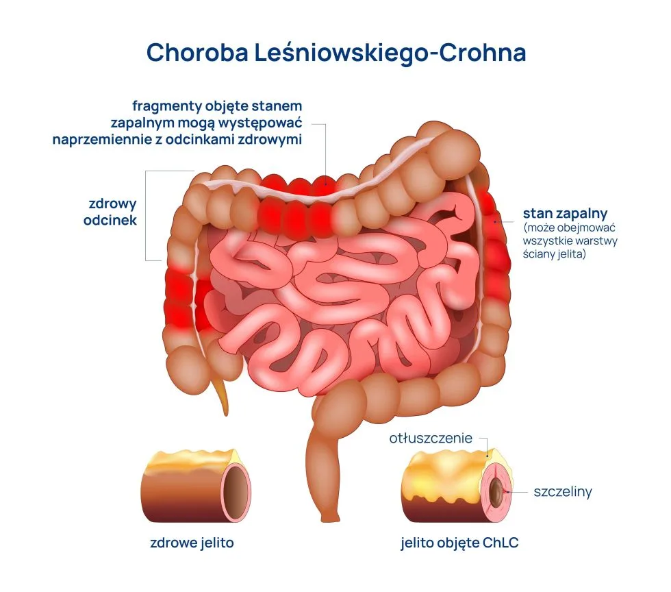 choroba Leśniowskiego-Crohna infografika