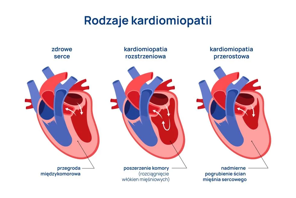 rodzaje kardiomiopatii infografika
