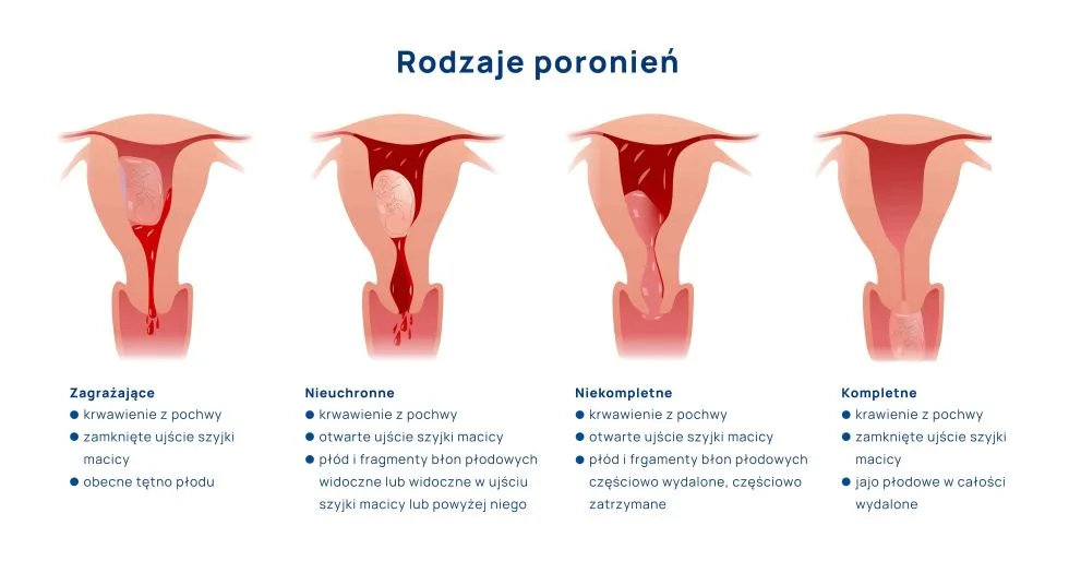 rodzaje poronień infografika