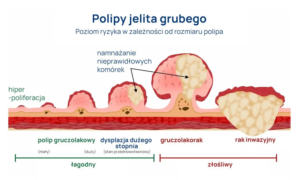 polipy jelita grubego poziom ryzyka rozwoju nowotworu infografika